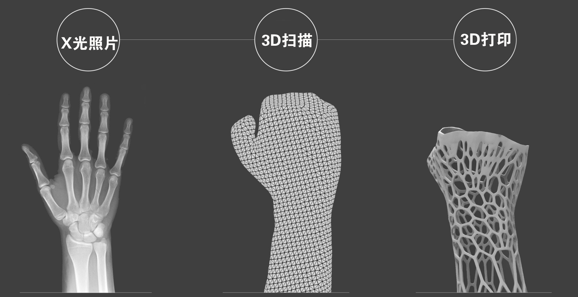 矯形器3D打印過程圖